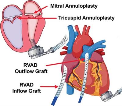 Case report: Facilitating right heart recovery after durable LVAD implantation through repair of atrioventricular valves and RVAD implantation using tunneled Dacron grafts